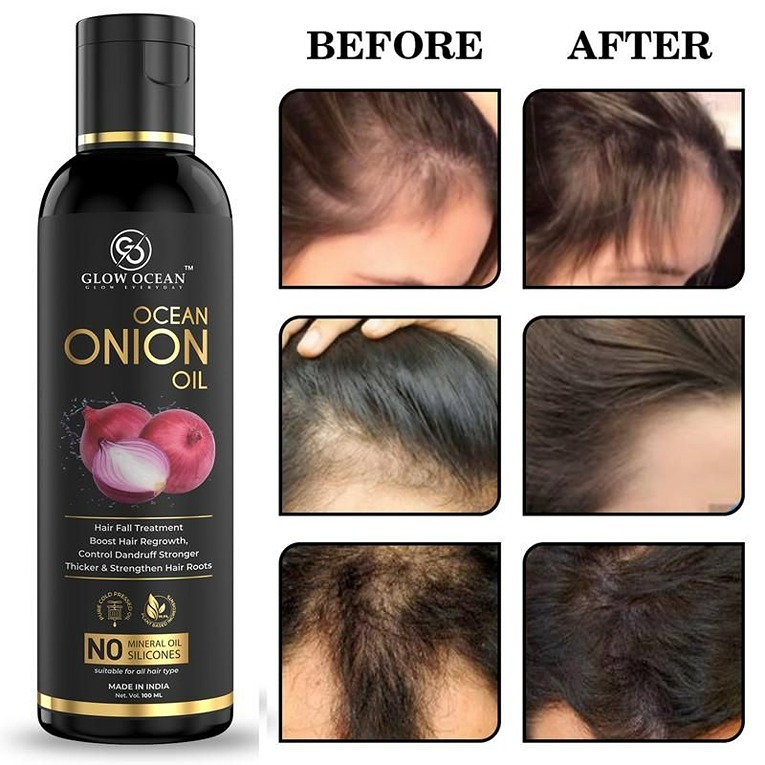 Ocean Onion oil For Hair Fall Control, Hair Growth & Hair Regrowth-Control  Dandruff (100Ml) (KDB-2016742) - StayHit - StayFit